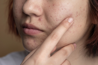 Jerawat Hormonal dan Cara Mengatasinya
